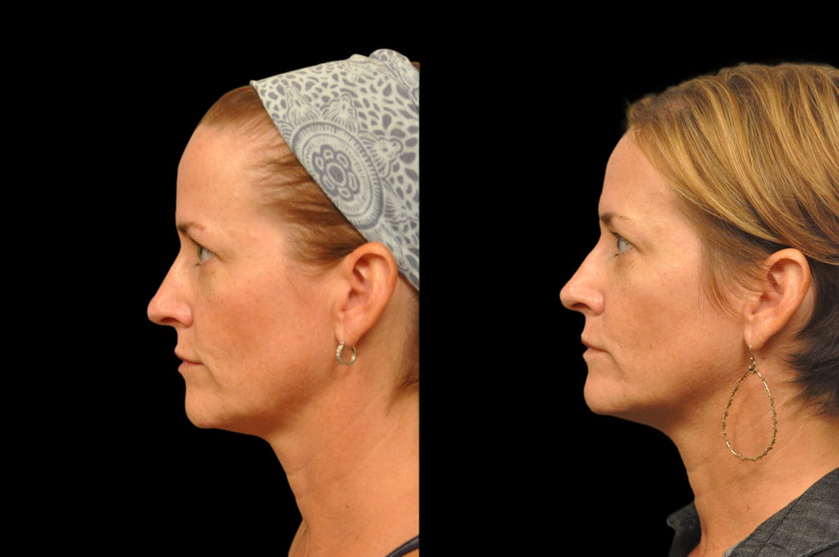 Injectables Before & After Gallery - Patient 234051 - Image 2