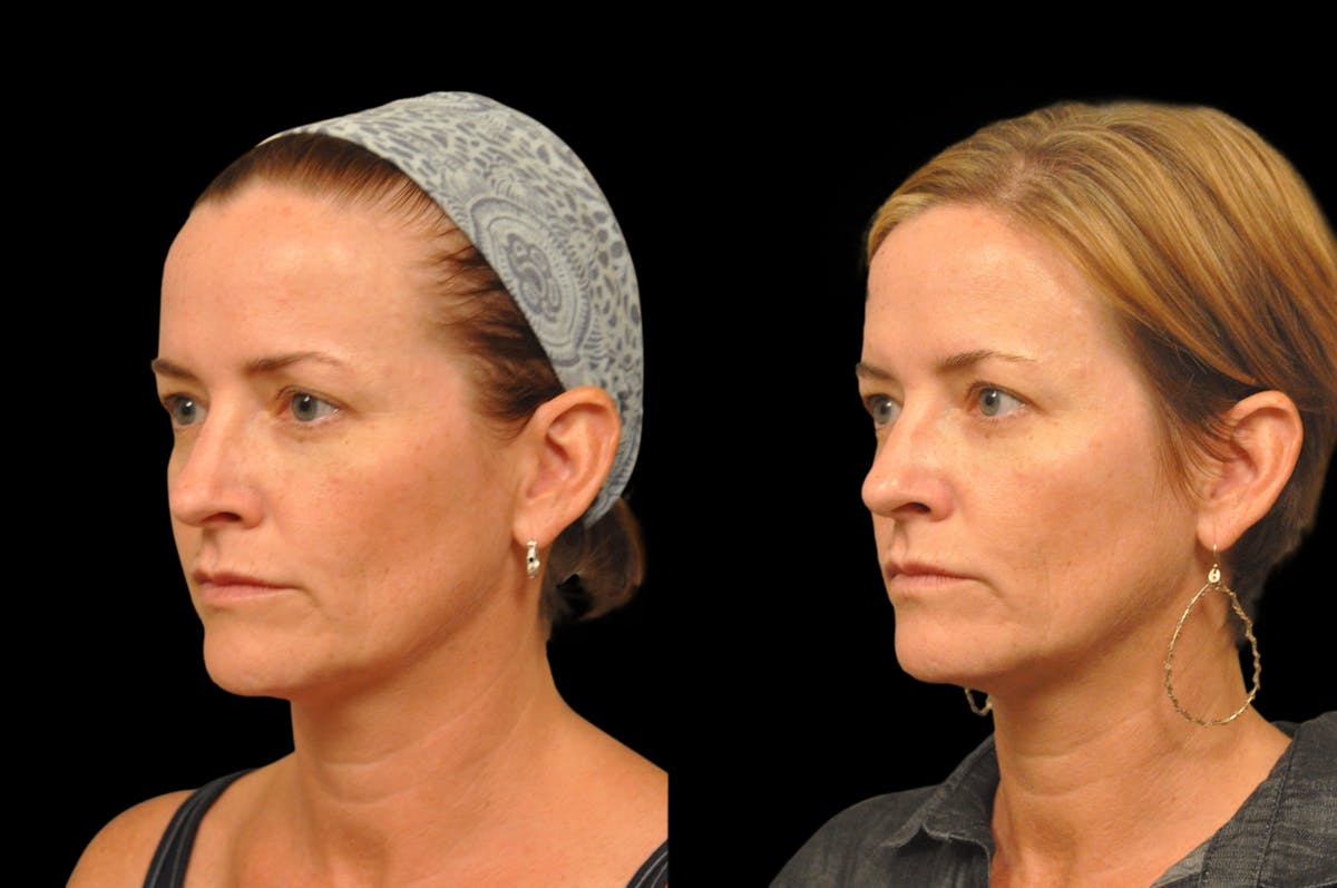 Injectables Before & After Gallery - Patient 234051 - Image 3
