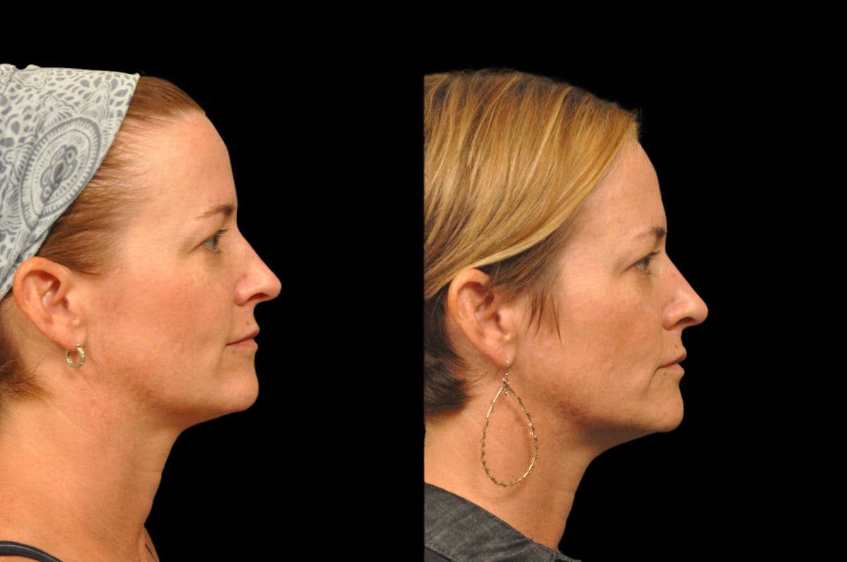 Injectables Before & After Gallery - Patient 234051 - Image 4