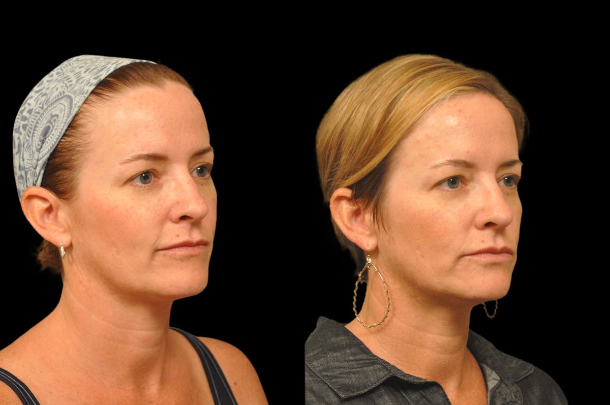 Injectables Before & After Gallery - Patient 234051 - Image 5
