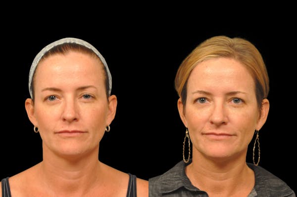 Injectables Before & After Gallery - Patient 234051 - Image 1