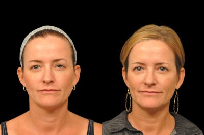 Injectables Before & After Gallery - Patient 234051 - Image 1