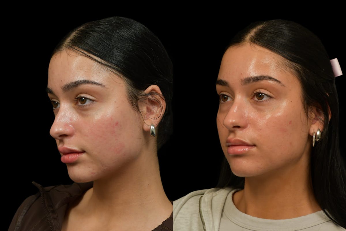 Lips Before & After Gallery - Patient 262830 - Image 3