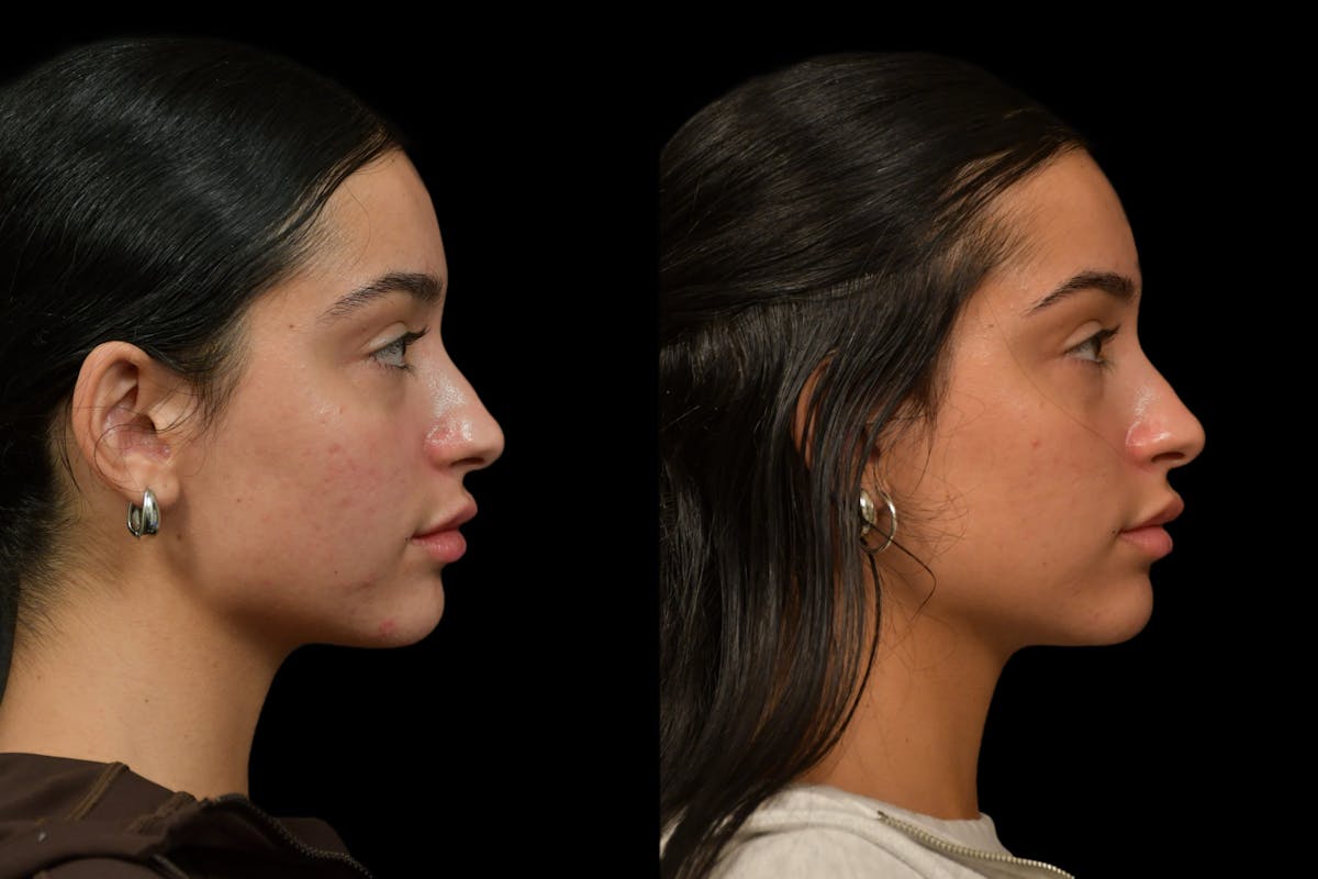 Lips Before & After Gallery - Patient 262830 - Image 4