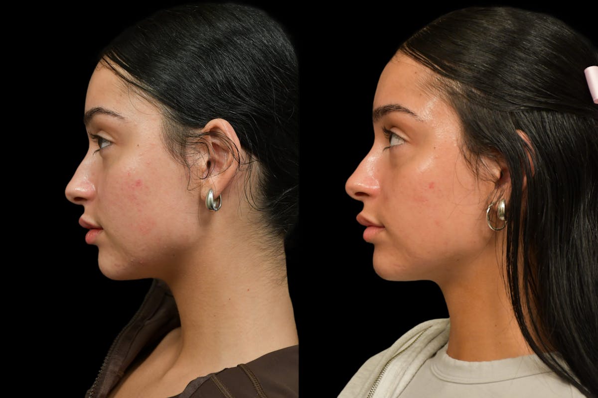 Lips Before & After Gallery - Patient 262830 - Image 5