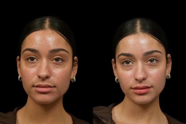 Injectables Before & After Gallery - Patient 333040 - Image 1