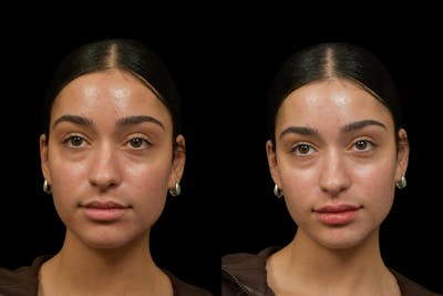 Injectables Before & After Gallery - Patient 333040 - Image 1