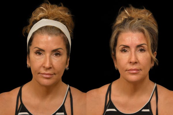 Injectables Before & After Gallery - Patient 188402 - Image 1