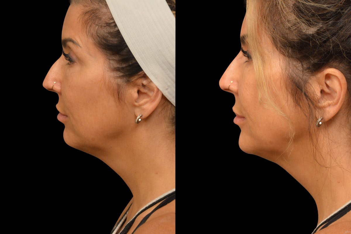 Injectables Before & After Gallery - Patient 188402 - Image 2