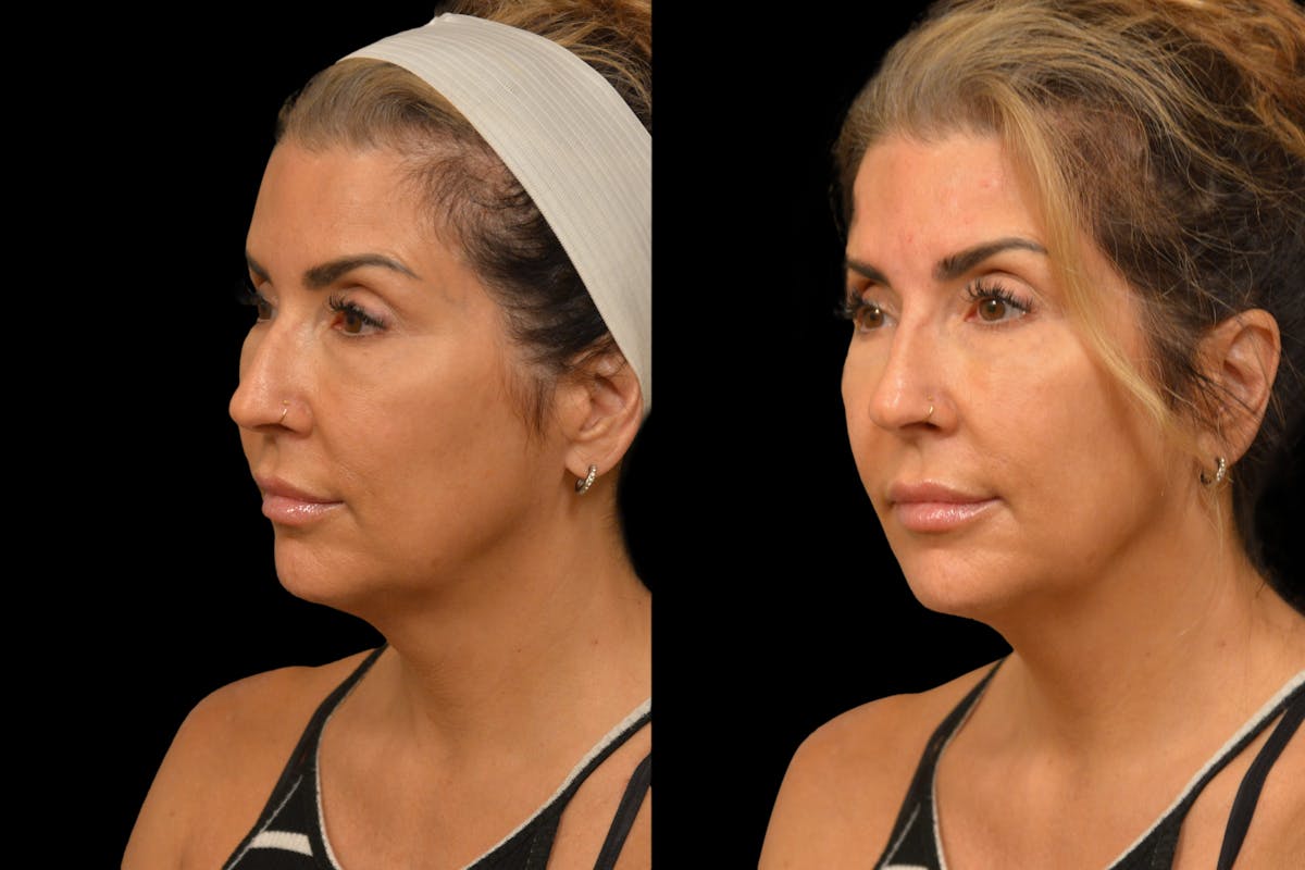 Injectables Before & After Gallery - Patient 188402 - Image 3