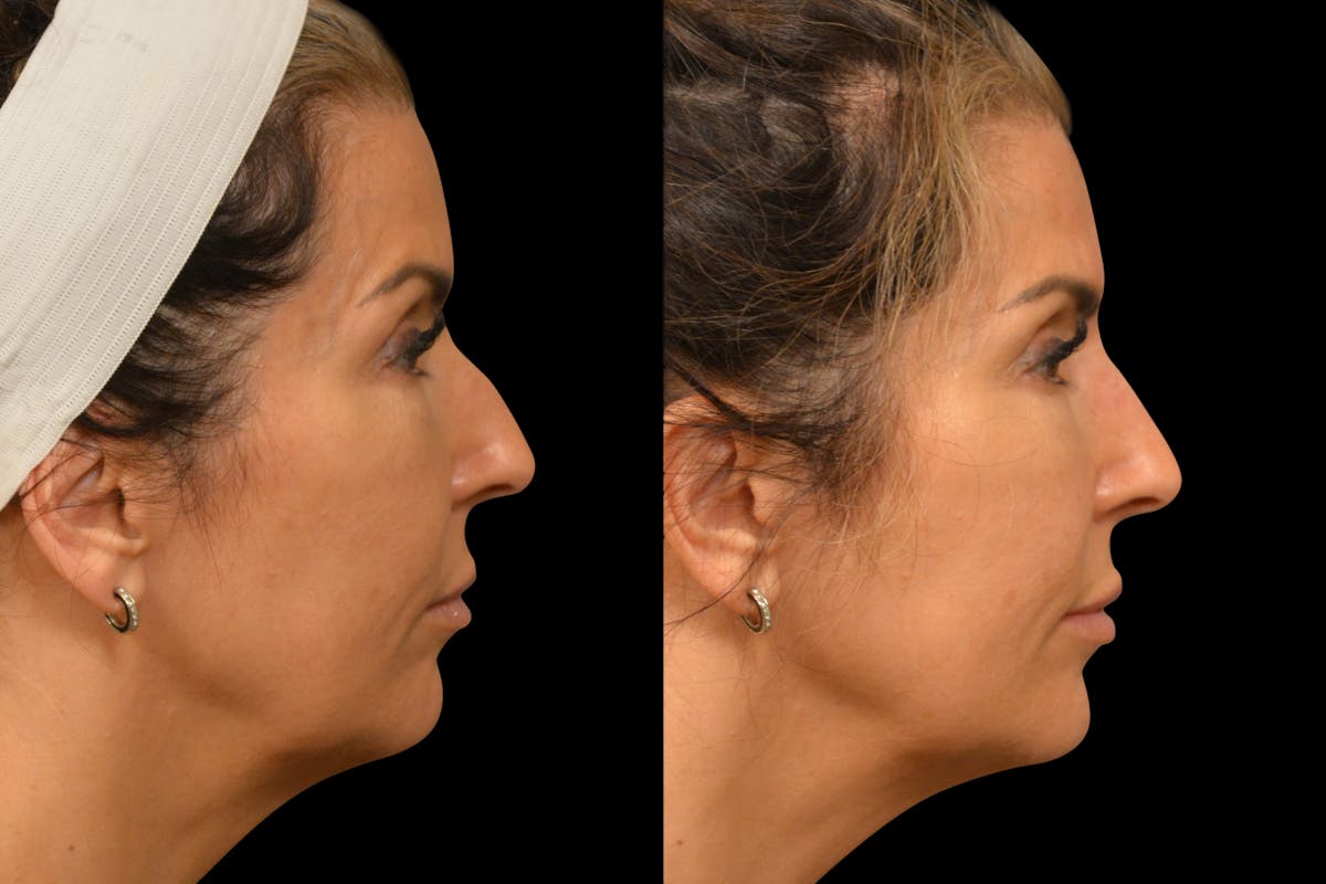 Injectables Before & After Gallery - Patient 188402 - Image 4