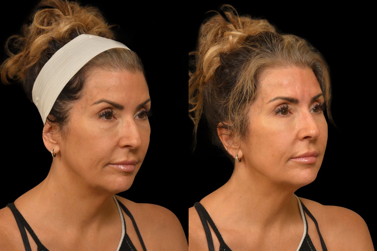Injectables Before & After Gallery - Patient 188402 - Image 5