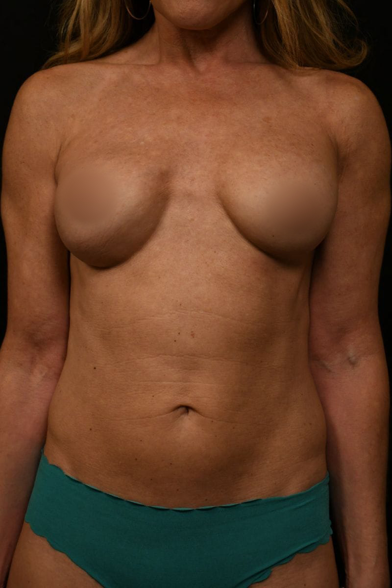 Breast Surgery Results
