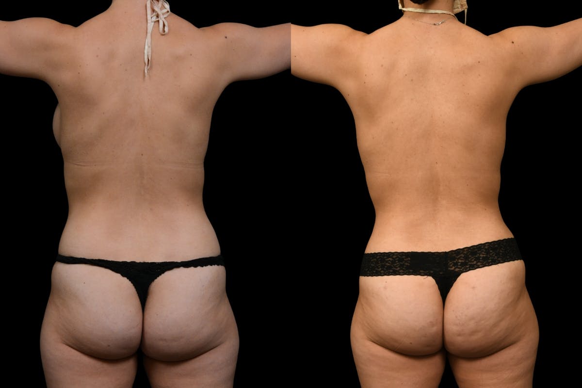 Mommy Makeover Before & After Gallery - Patient 312850 - Image 6