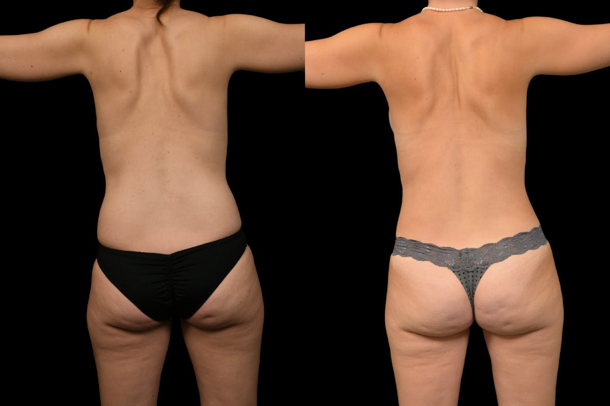 Mommy Makeover Before & After Gallery - Patient 315942 - Image 6