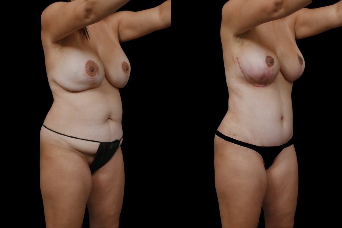 Mommy Makeover Before & After Gallery - Patient 126867 - Image 2