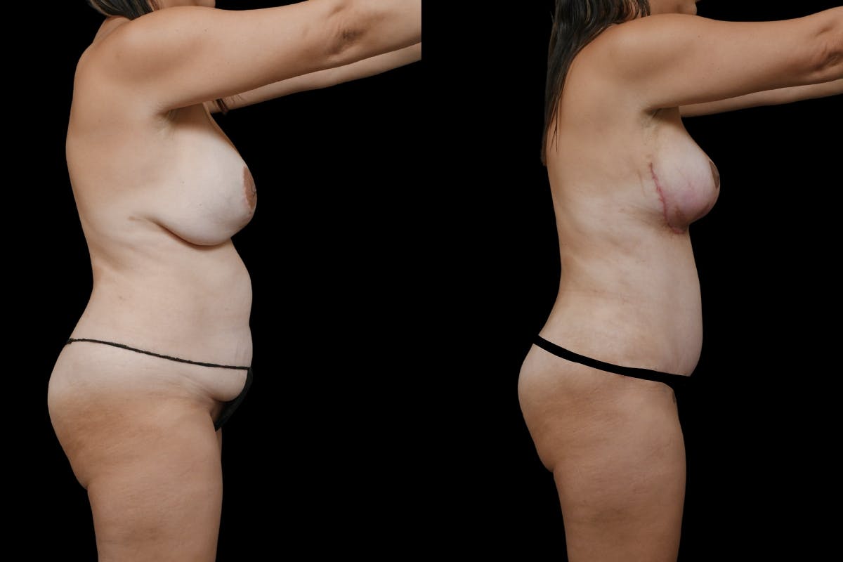 Mommy Makeover Before & After Gallery - Patient 126867 - Image 3