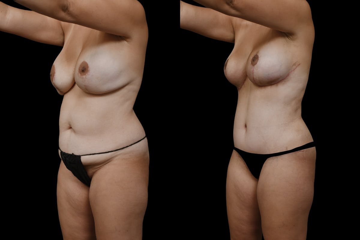 Mommy Makeover Before & After Gallery - Patient 126867 - Image 4