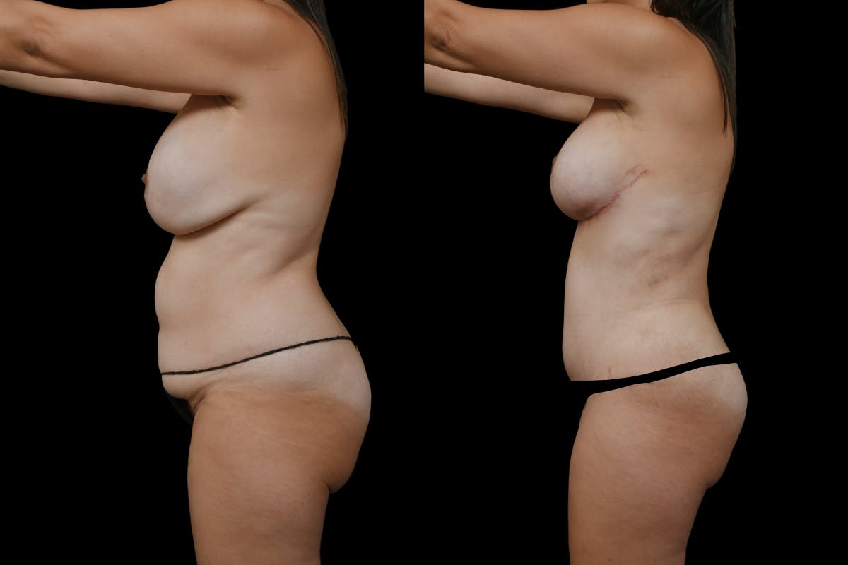 Mommy Makeover Before & After Gallery - Patient 126867 - Image 5