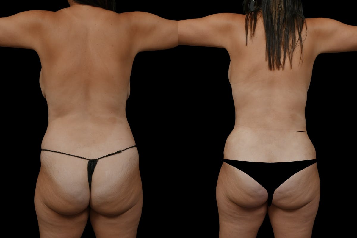 Mommy Makeover Before & After Gallery - Patient 126867 - Image 6