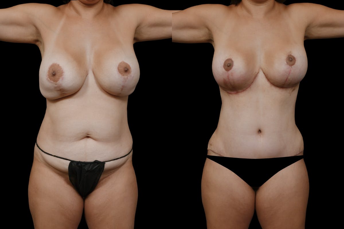 Mommy Makeover Before & After Gallery - Patient 126867 - Image 1