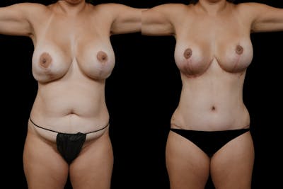 Mommy Makeover Before & After Gallery - Patient 126867 - Image 1