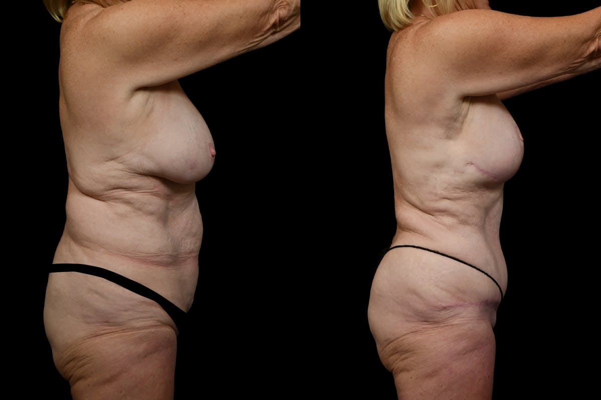 Mommy Makeover Before & After Gallery - Patient 179090 - Image 3