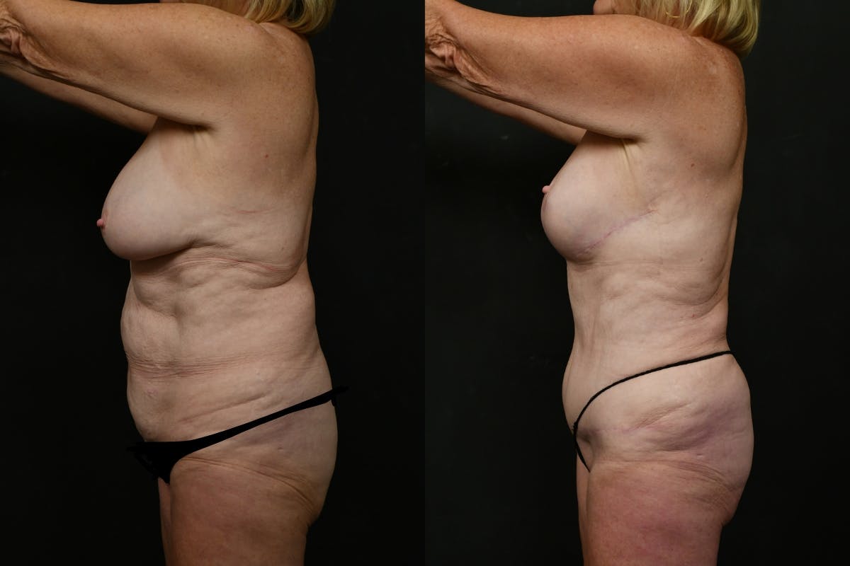 Mommy Makeover Before & After Gallery - Patient 179090 - Image 5