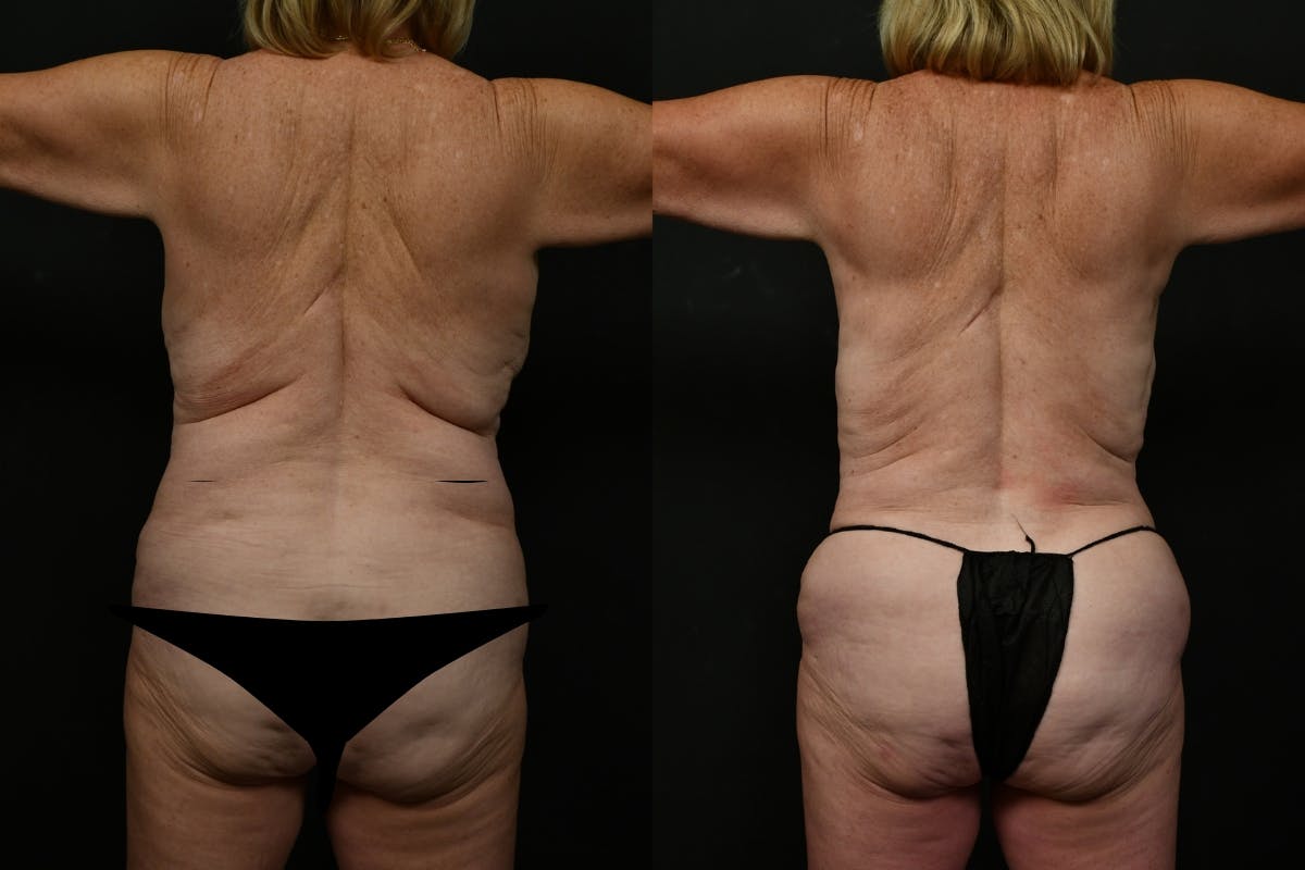Mommy Makeover Before & After Gallery - Patient 179090 - Image 6