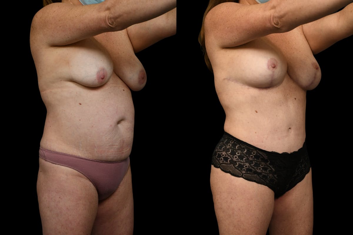 Tummy Tuck Before & After Gallery - Patient 267771 - Image 4