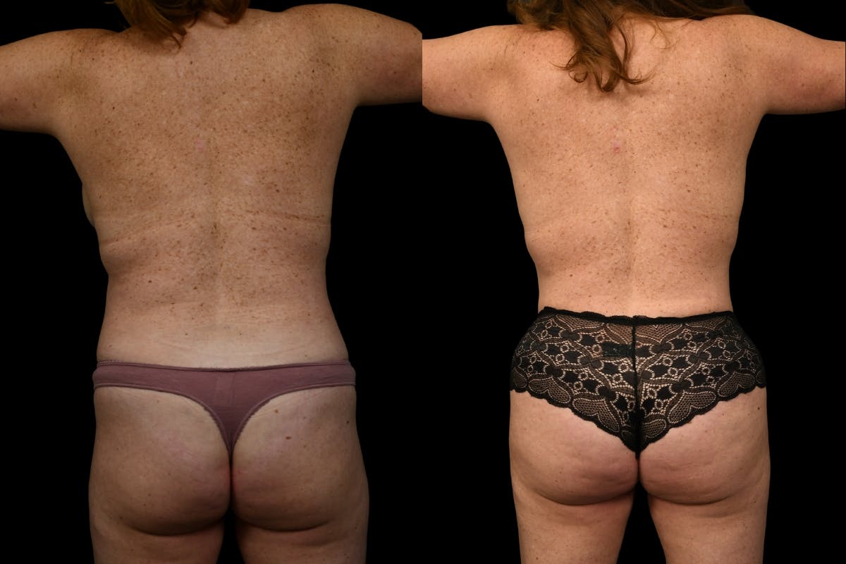 Tummy Tuck Before & After Gallery - Patient 267771 - Image 6