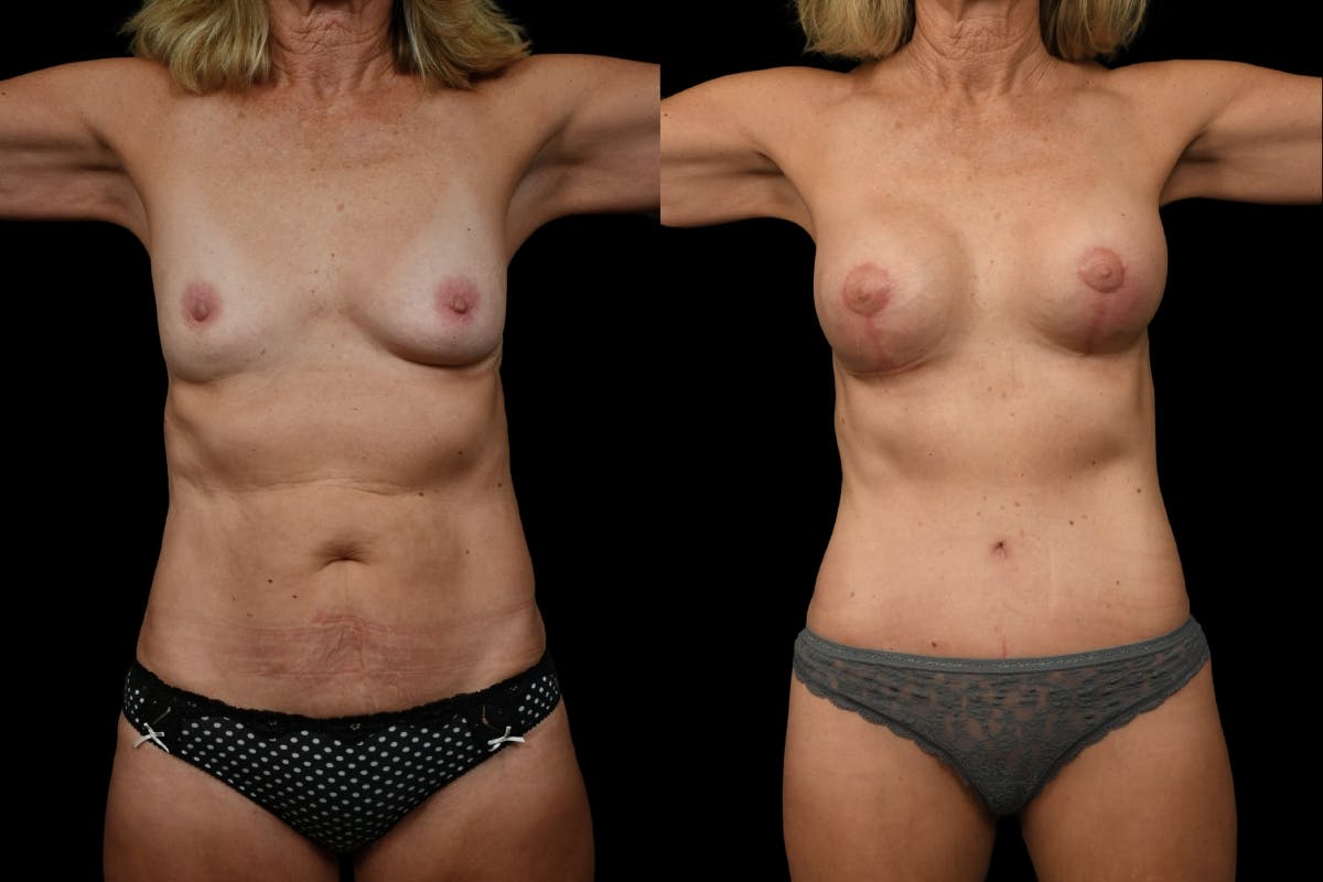 Breast Lift Before & After Gallery - Patient 105730 - Image 1