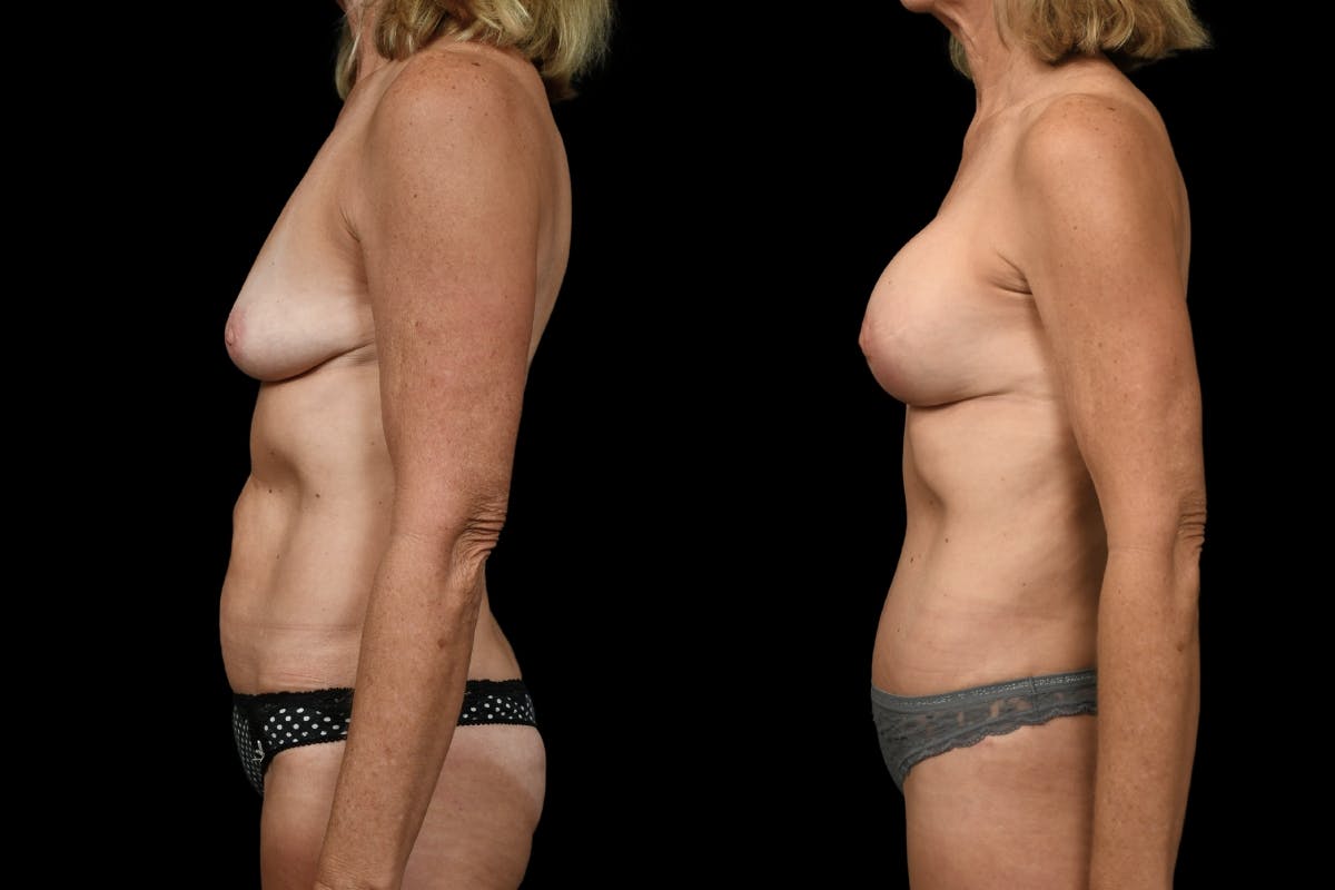 Breast Lift Before & After Gallery - Patient 105730 - Image 3