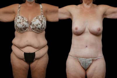 Mommy Makeover Before & After Gallery - Patient 142865 - Image 1