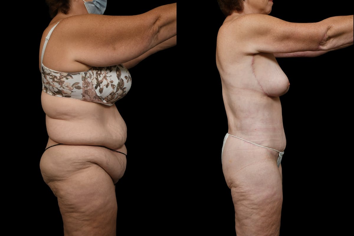 Autologous Implant Before & After Gallery - Patient 319220 - Image 3