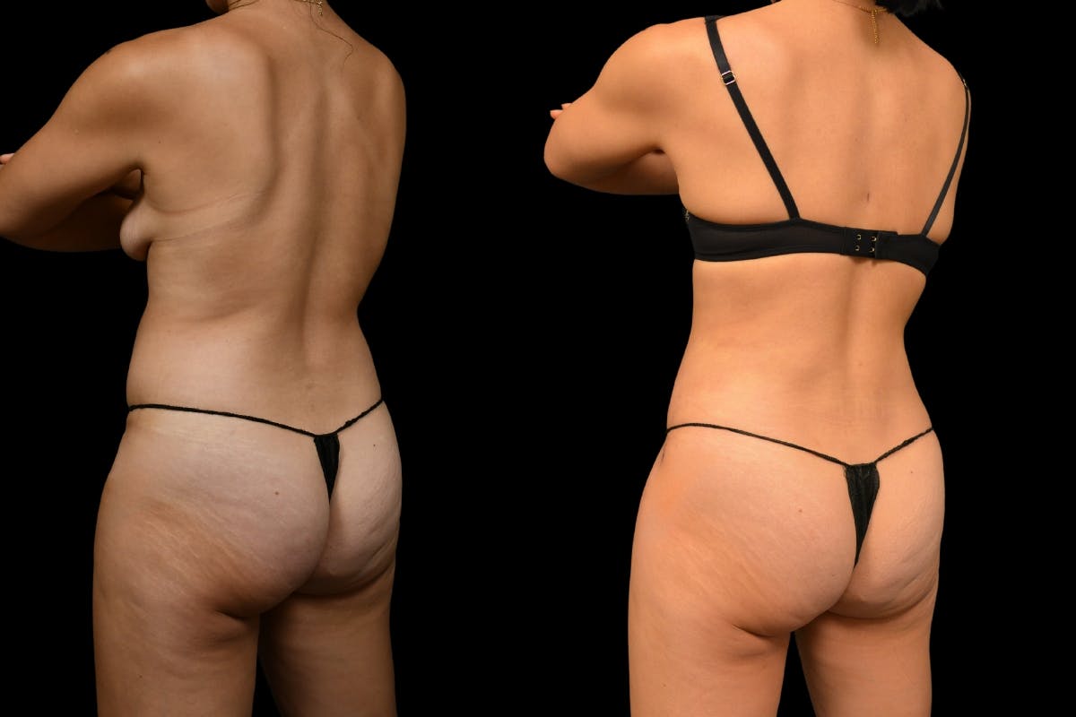 Tummy Tuck Before & After Gallery - Patient 148243 - Image 6