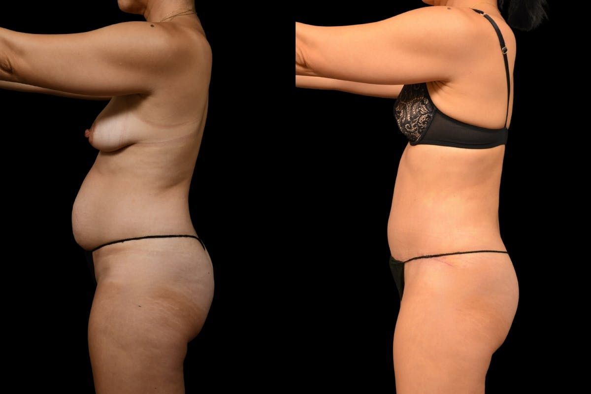 Tummy Tuck Before & After Gallery - Patient 148243 - Image 7