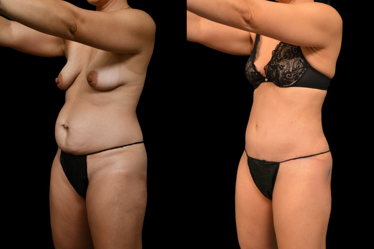 Tummy Tuck Before & After Gallery - Patient 148243 - Image 8