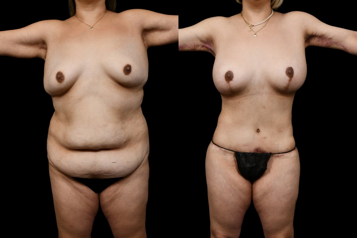 Massive Weight Loss Before & After Gallery - Patient 353557 - Image 1