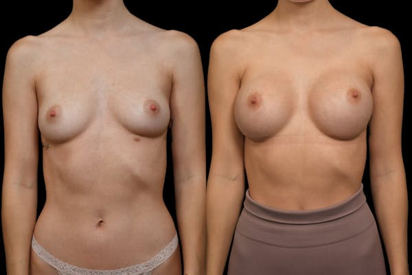Breast Augmentation Before & After Gallery - Patient 308687 - Image 1