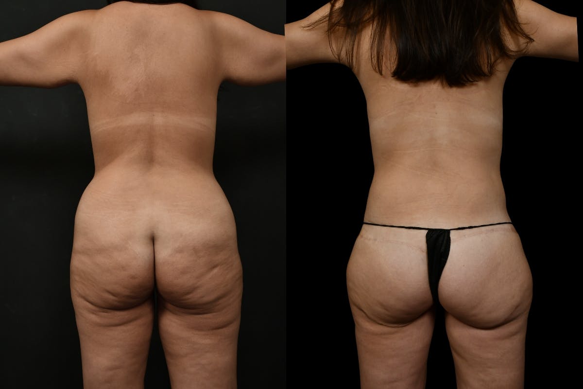 Massive Weight Loss Before & After Gallery - Patient 247035 - Image 4