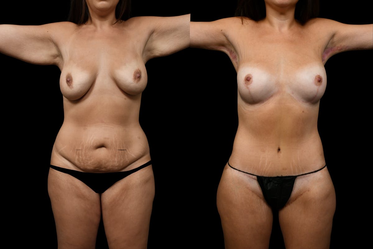 Massive Weight Loss Before & After Gallery - Patient 247035 - Image 1
