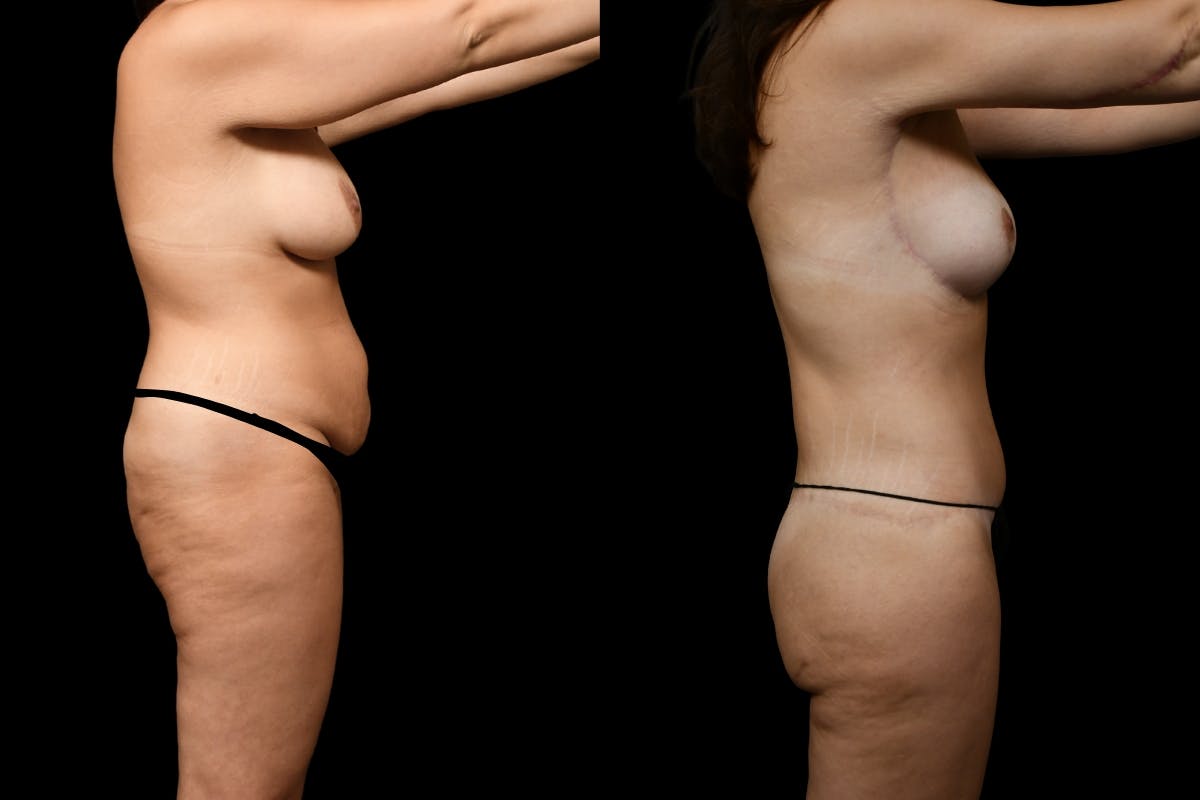 Massive Weight Loss Before & After Gallery - Patient 247035 - Image 6