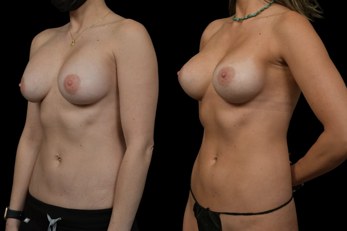 Breast Revision Before & After Gallery - Patient 267041 - Image 4