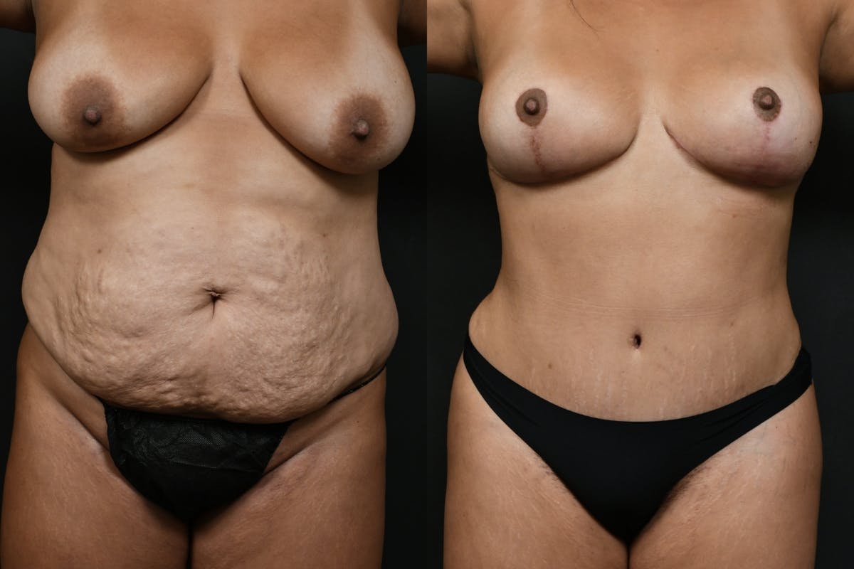 Mommy Makeover Before & After Gallery - Patient 200783 - Image 1