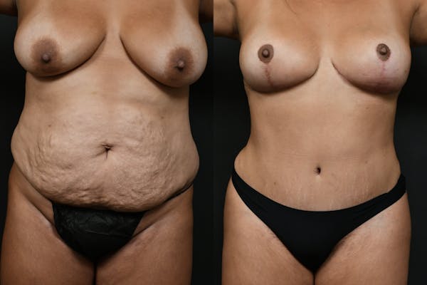 Mommy Makeover Before & After Gallery - Patient 200783 - Image 1