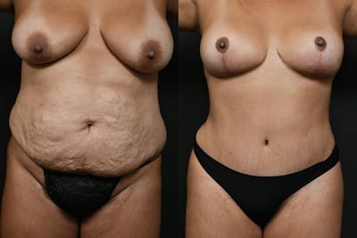 Mommy Makeover Before & After Gallery - Patient 200783 - Image 1