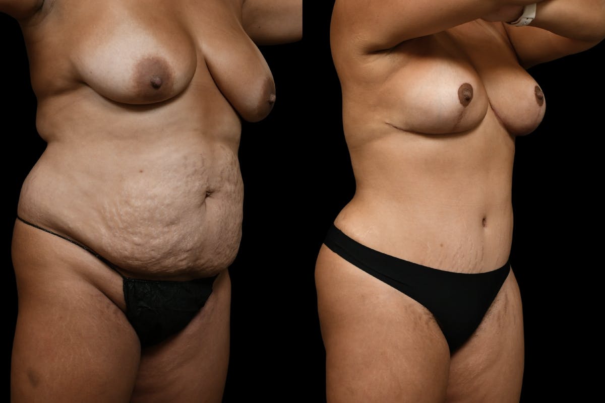 Mommy Makeover Before & After Gallery - Patient 200783 - Image 2