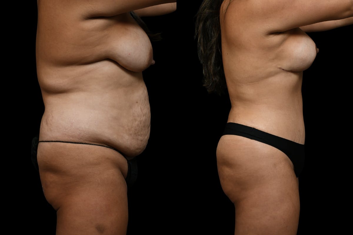 Mommy Makeover Before & After Gallery - Patient 200783 - Image 3