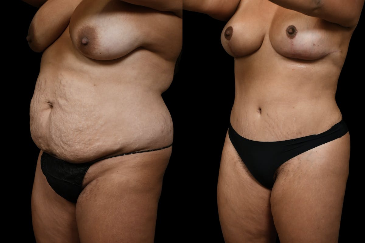 Mommy Makeover Before & After Gallery - Patient 200783 - Image 4